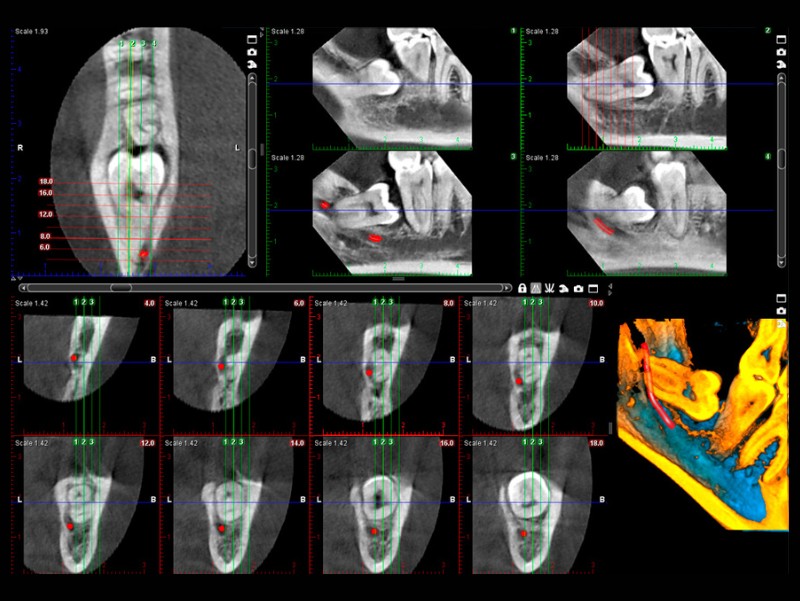 promax 3d classic wisdom tooth