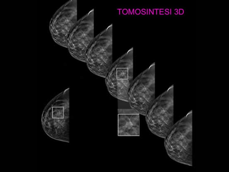 Senologia Filograna con tomosintesi 3D